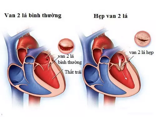 Bị hẹp van tim 2 lá có nhất thiết phải nong van tim có được không?